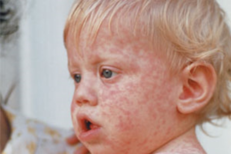 measles_300x200.jpg