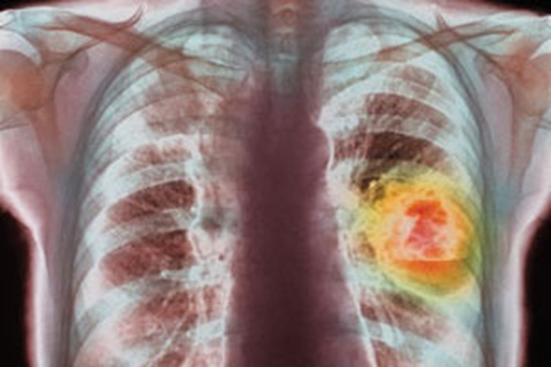 lung-cancer_3x2.jpg