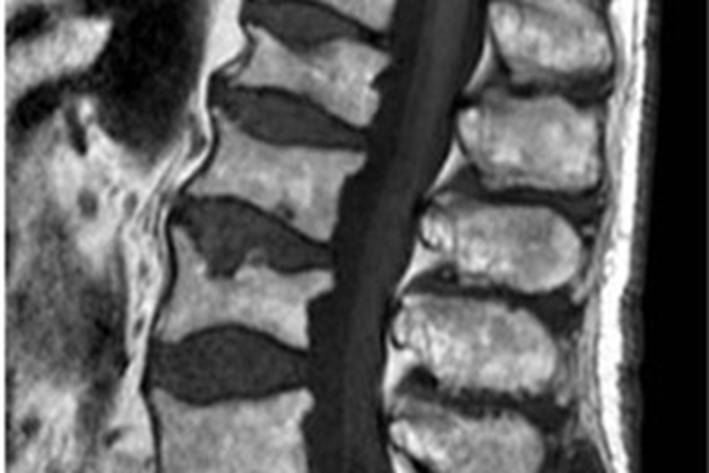 osteoporosis-3x2.jpg