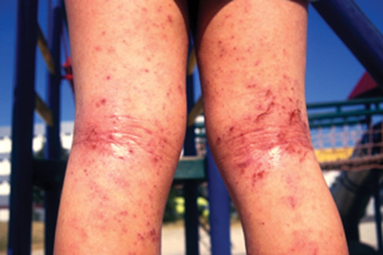 infected-eczema.jpg