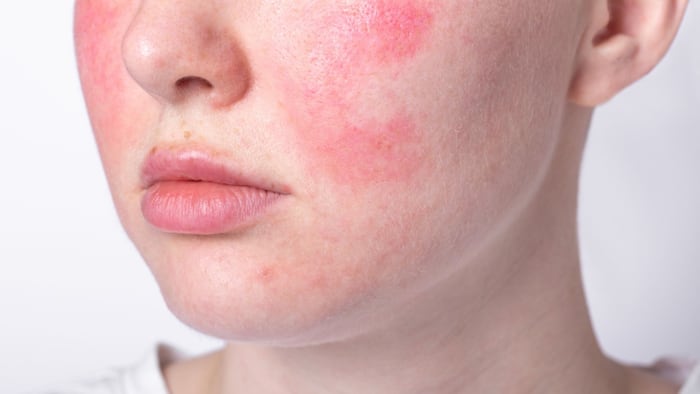rosacea