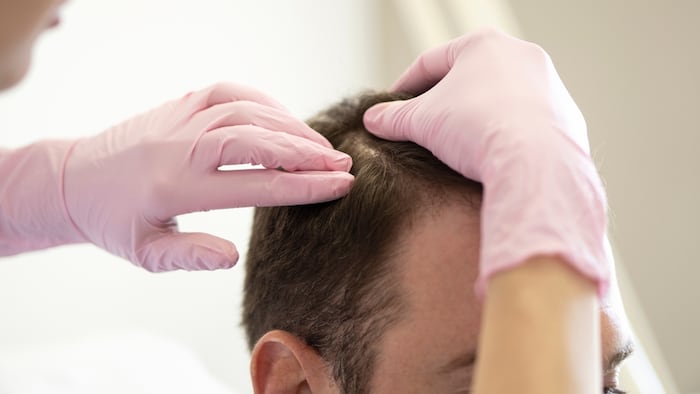 Image of doctor examining scalp of a patient with potential hair loss