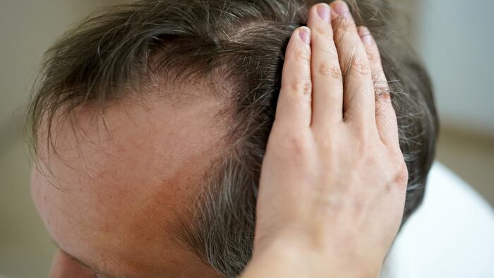 Hair loss