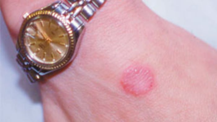 Ringworm_3x2.jpg