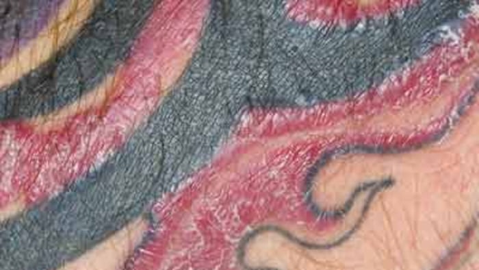 Tattoo-Allergy.jpg
