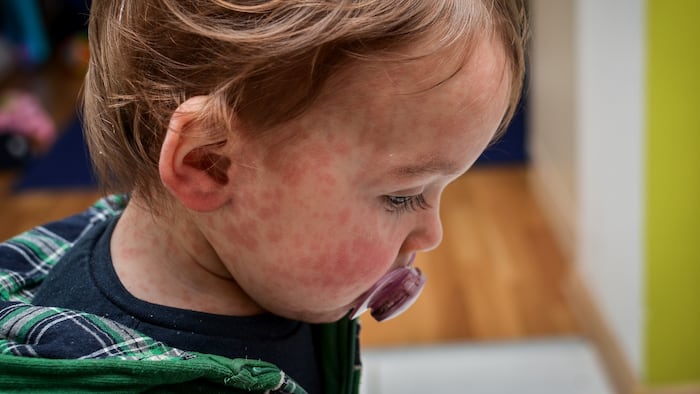 Child with measles